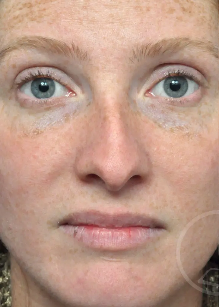 Plastic Surgery Before and After Pictures in Jacksonville, FL - Garcia Facial Plastic Surgery