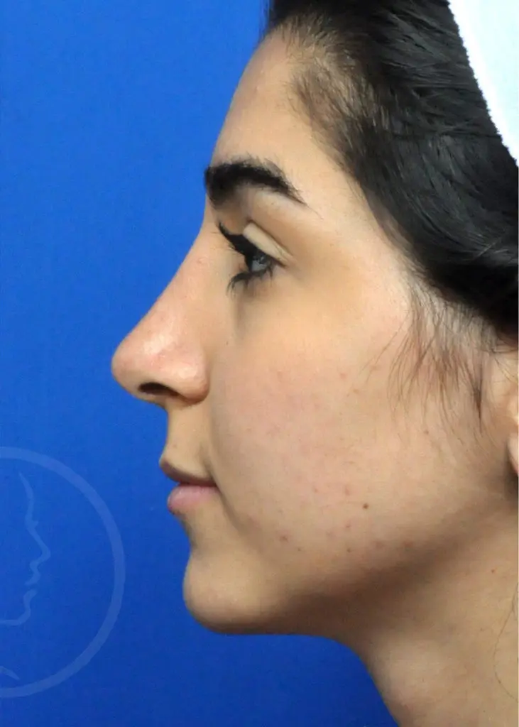 Plastic Surgery Before and After Pictures in Jacksonville, FL - Garcia Facial Plastic Surgery