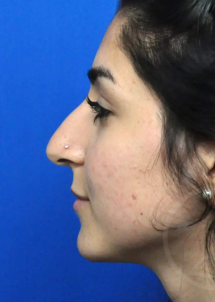 Plastic Surgery Before and After Pictures in Jacksonville, FL - Garcia Facial Plastic Surgery