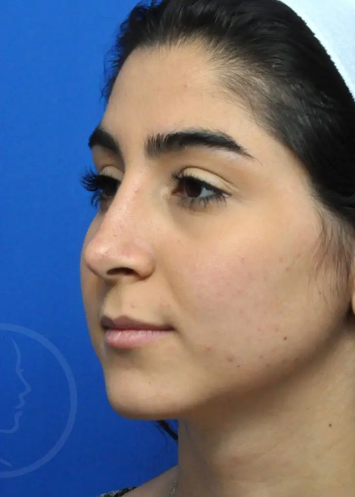 Plastic Surgery Before and After Pictures in Jacksonville, FL - Garcia Facial Plastic Surgery
