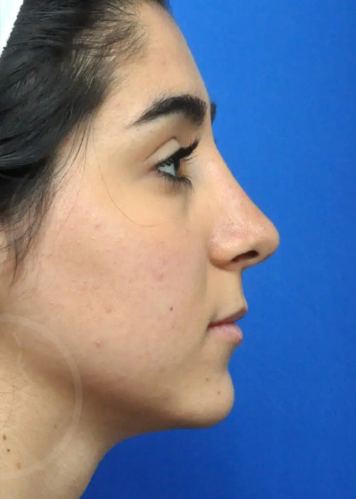 Plastic Surgery Before and After Pictures in Jacksonville, FL - Garcia Facial Plastic Surgery