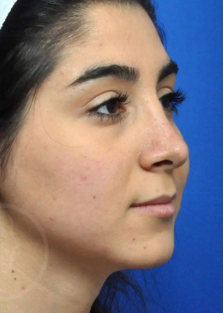Plastic Surgery Before and After Pictures in Jacksonville, FL - Garcia Facial Plastic Surgery