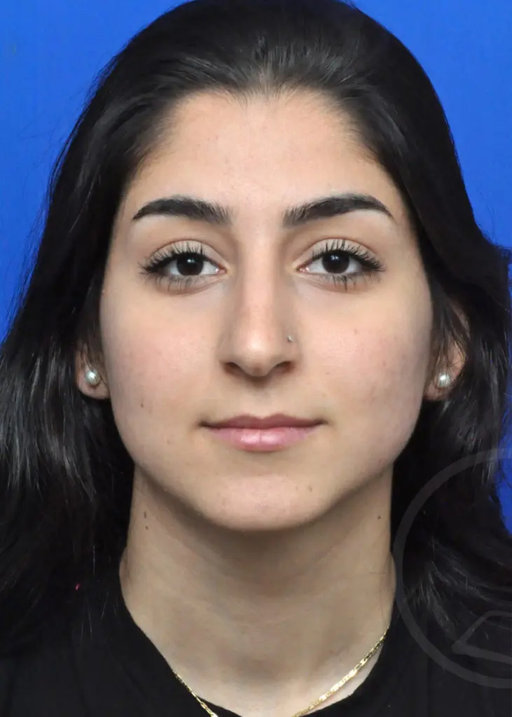 Plastic Surgery Before and After Pictures in Jacksonville, FL - Garcia Facial Plastic Surgery