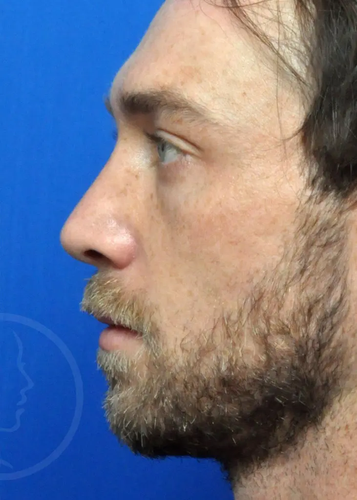 Plastic Surgery Before and After Pictures in Jacksonville, FL - Garcia Facial Plastic Surgery