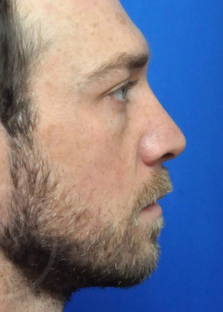 Plastic Surgery Before and After Pictures in Jacksonville, FL - Garcia Facial Plastic Surgery