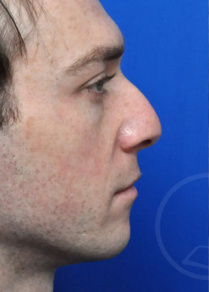 Plastic Surgery Before and After Pictures in Jacksonville, FL - Garcia Facial Plastic Surgery