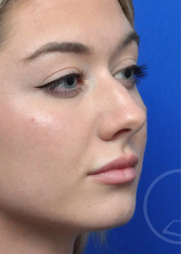 Plastic Surgery Before and After Pictures in Jacksonville, FL - Garcia Facial Plastic Surgery