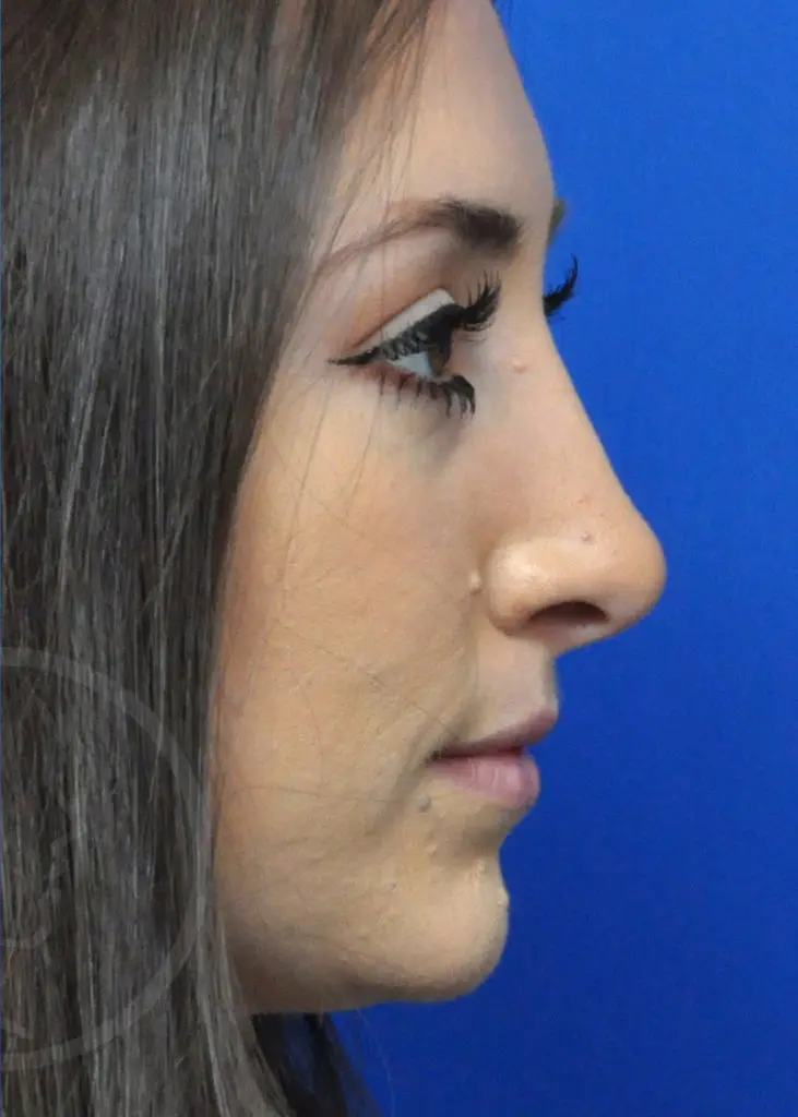 Plastic Surgery Before and After Pictures in Jacksonville, FL - Garcia Facial Plastic Surgery