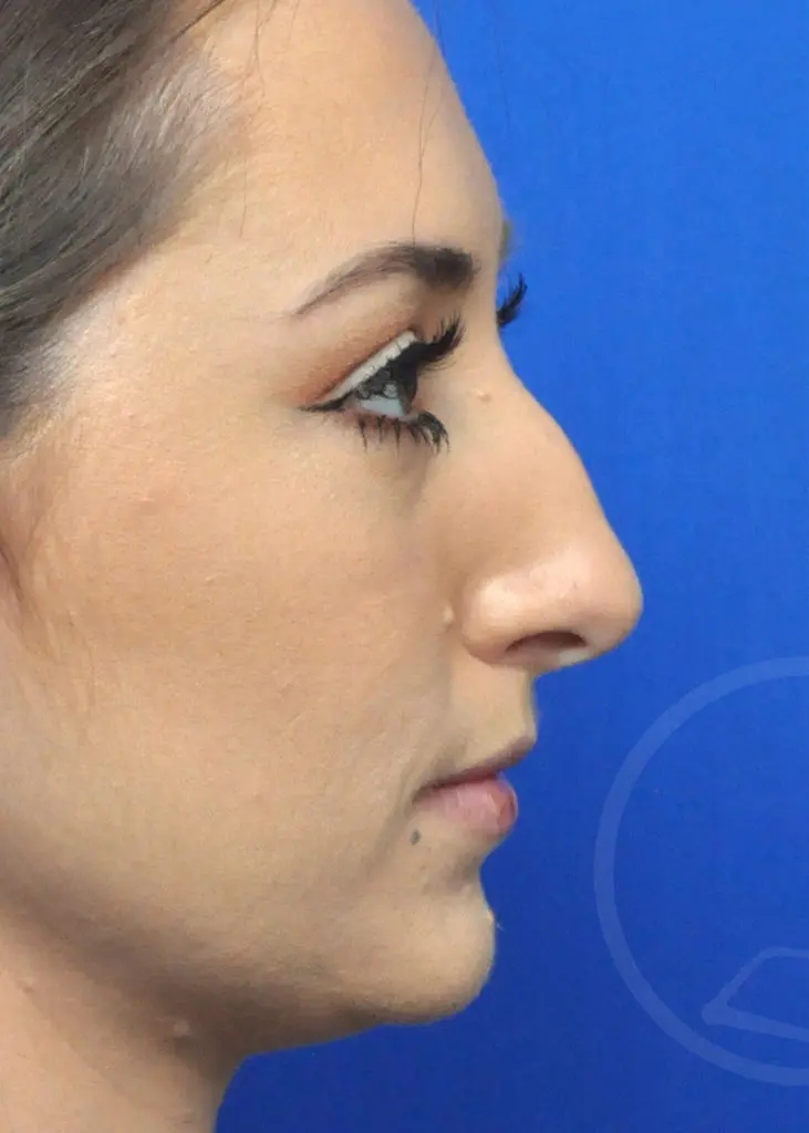 Plastic Surgery Before and After Pictures in Jacksonville, FL - Garcia Facial Plastic Surgery