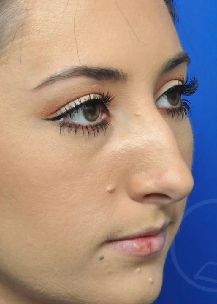 Plastic Surgery Before and After Pictures in Jacksonville, FL - Garcia Facial Plastic Surgery