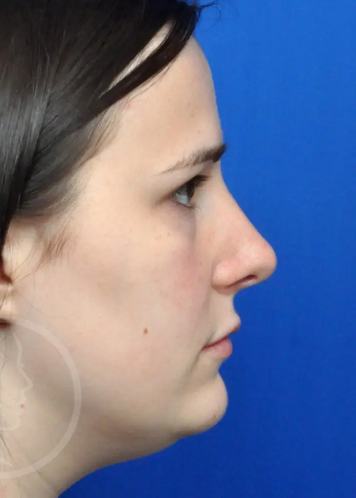 Plastic Surgery Before and After Pictures in Jacksonville, FL - Garcia Facial Plastic Surgery