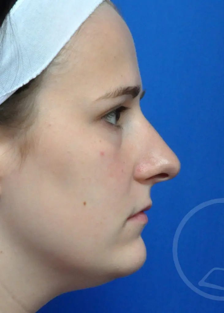 Plastic Surgery Before and After Pictures in Jacksonville, FL - Garcia Facial Plastic Surgery