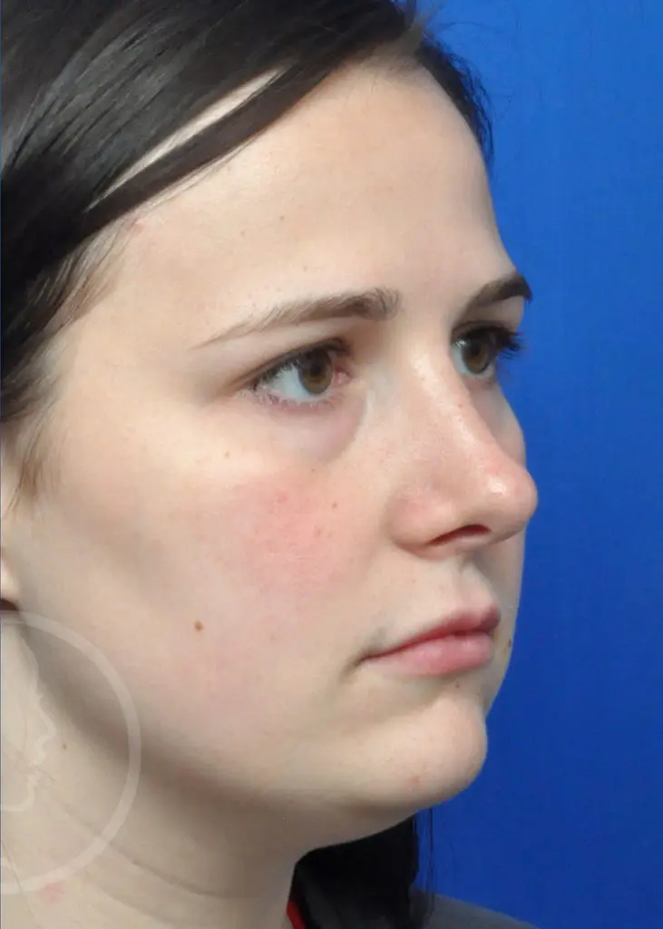 Plastic Surgery Before and After Pictures in Jacksonville, FL - Garcia Facial Plastic Surgery