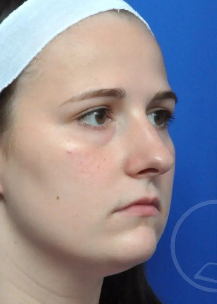 Plastic Surgery Before and After Pictures in Jacksonville, FL - Garcia Facial Plastic Surgery