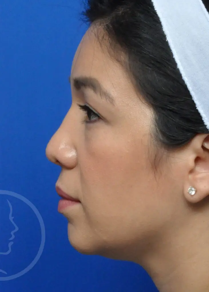 Plastic Surgery Before and After Pictures in Jacksonville, FL - Garcia Facial Plastic Surgery