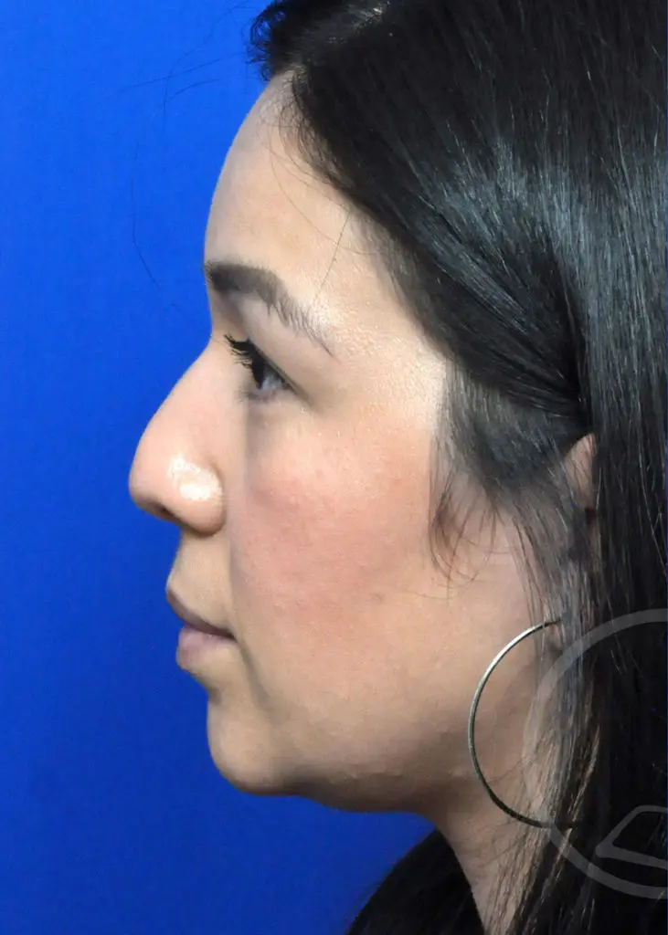 Plastic Surgery Before and After Pictures in Jacksonville, FL - Garcia Facial Plastic Surgery