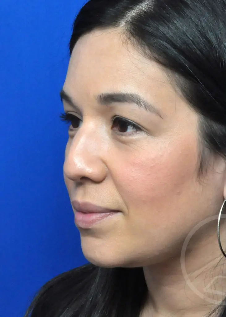 Plastic Surgery Before and After Pictures in Jacksonville, FL - Garcia Facial Plastic Surgery