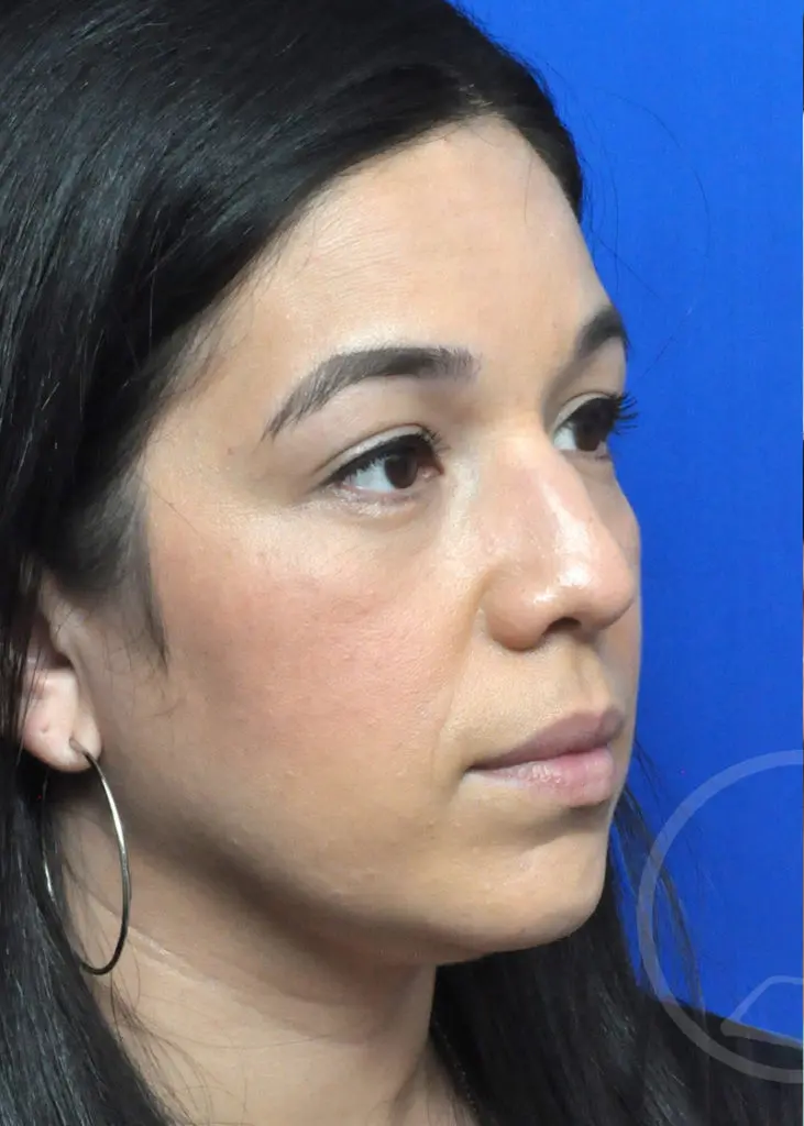 Plastic Surgery Before and After Pictures in Jacksonville, FL - Garcia Facial Plastic Surgery