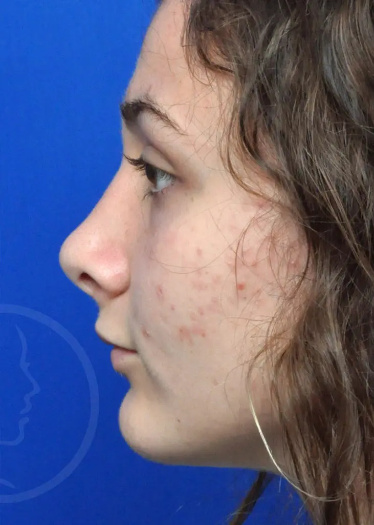 Plastic Surgery Before and After Pictures in Jacksonville, FL - Garcia Facial Plastic Surgery