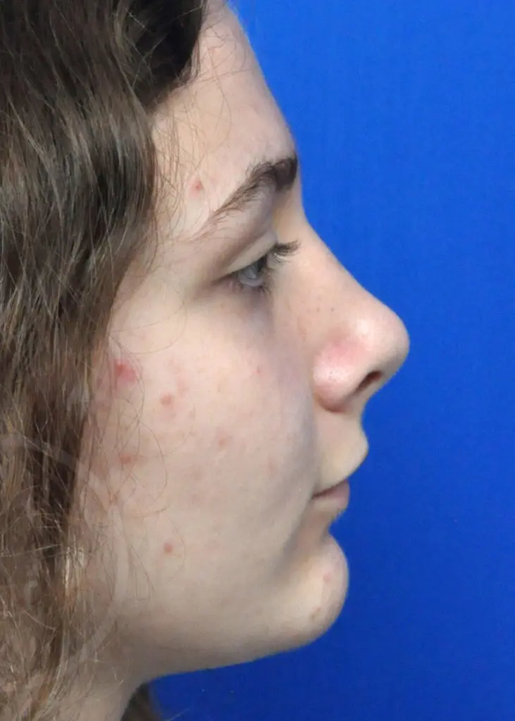 Plastic Surgery Before and After Pictures in Jacksonville, FL - Garcia Facial Plastic Surgery