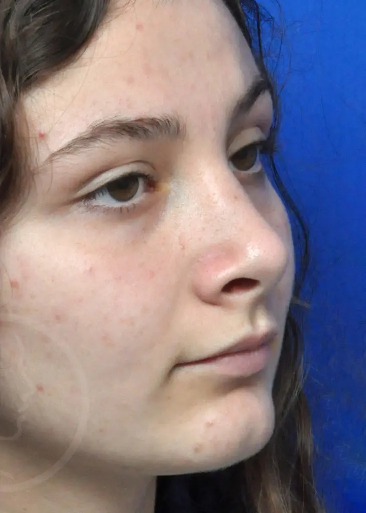 Plastic Surgery Before and After Pictures in Jacksonville, FL - Garcia Facial Plastic Surgery