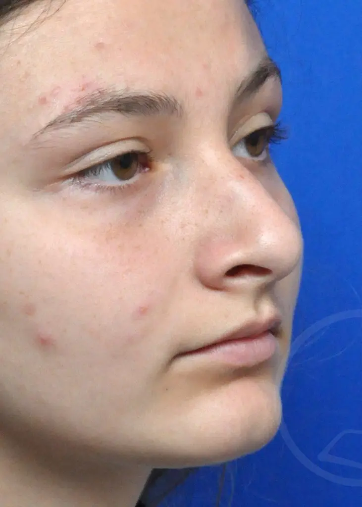 Plastic Surgery Before and After Pictures in Jacksonville, FL - Garcia Facial Plastic Surgery