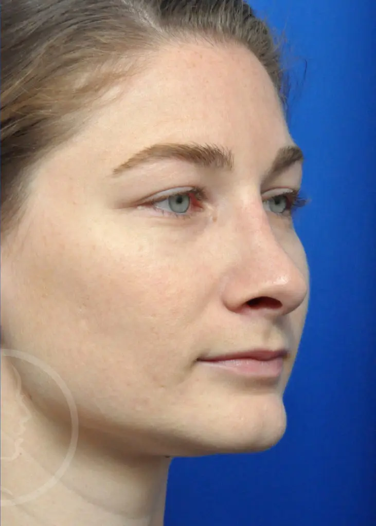 Plastic Surgery Before and After Pictures in Jacksonville, FL - Garcia Facial Plastic Surgery