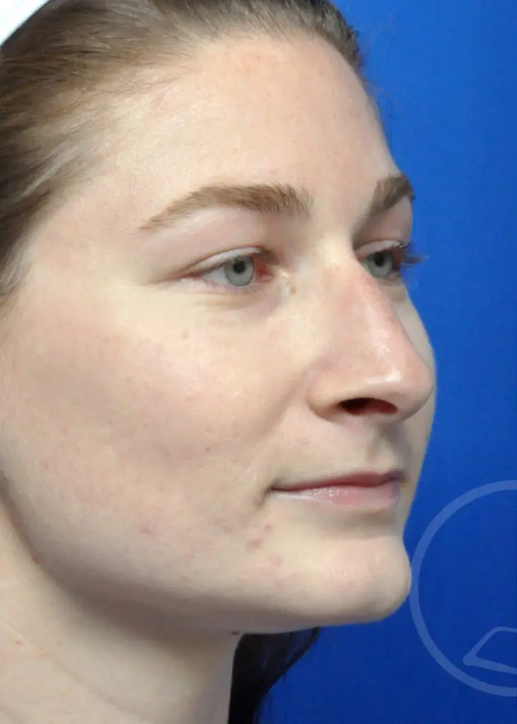 Plastic Surgery Before and After Pictures in Jacksonville, FL - Garcia Facial Plastic Surgery