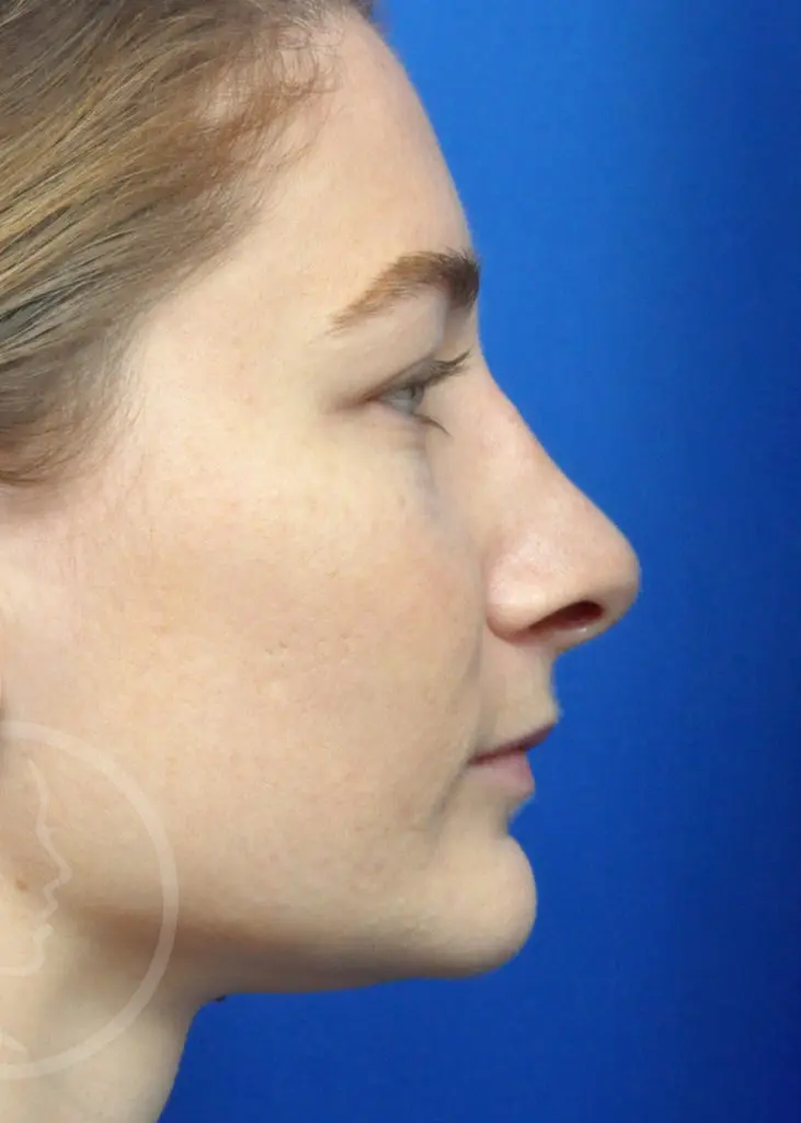 Plastic Surgery Before and After Pictures in Jacksonville, FL - Garcia Facial Plastic Surgery