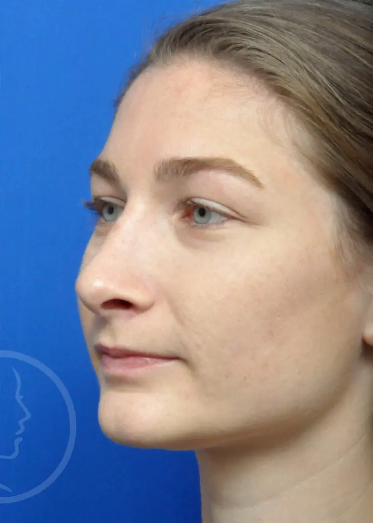 Plastic Surgery Before and After Pictures in Jacksonville, FL - Garcia Facial Plastic Surgery