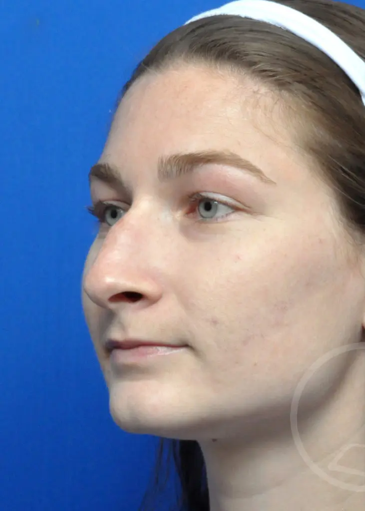 Plastic Surgery Before and After Pictures in Jacksonville, FL - Garcia Facial Plastic Surgery