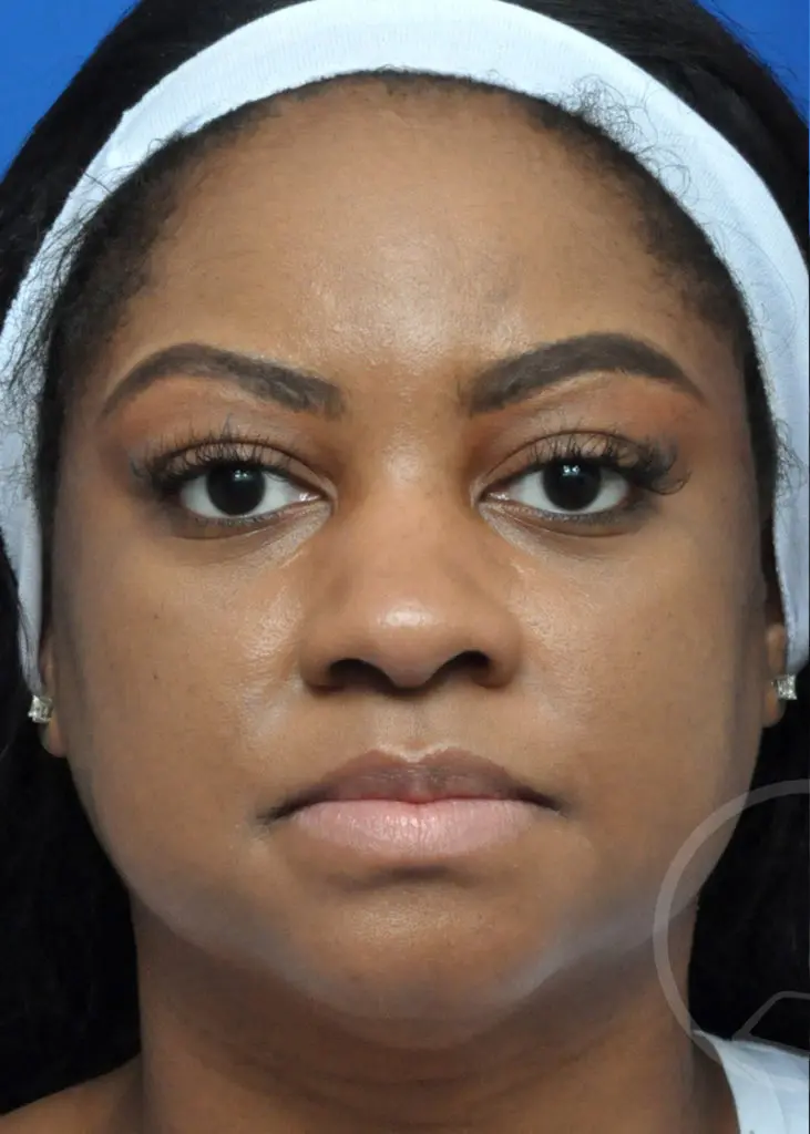 Plastic Surgery Before and After Pictures in Jacksonville, FL - Garcia Facial Plastic Surgery