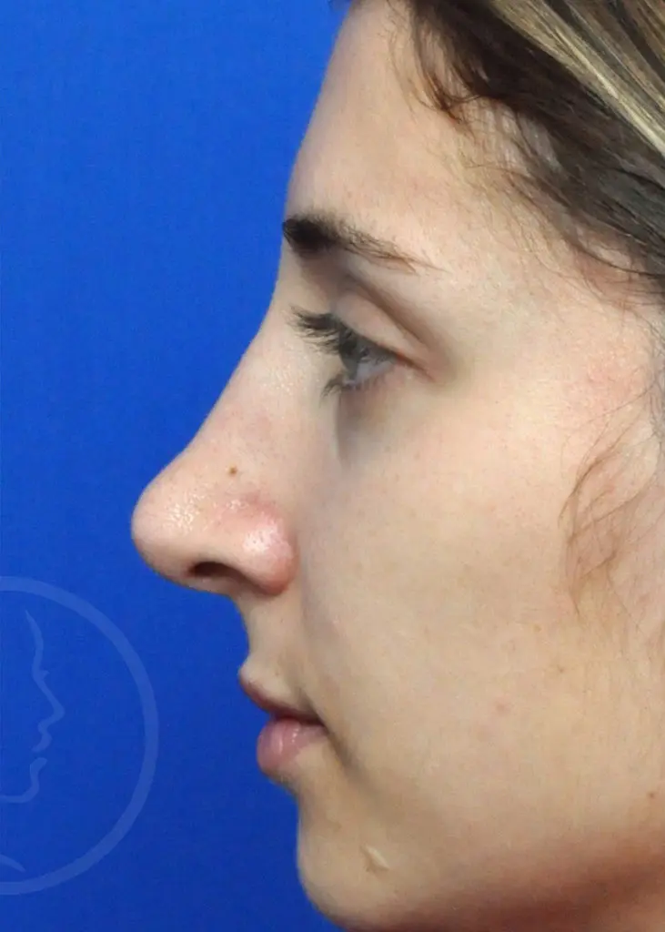 Plastic Surgery Before and After Pictures in Jacksonville, FL - Garcia Facial Plastic Surgery