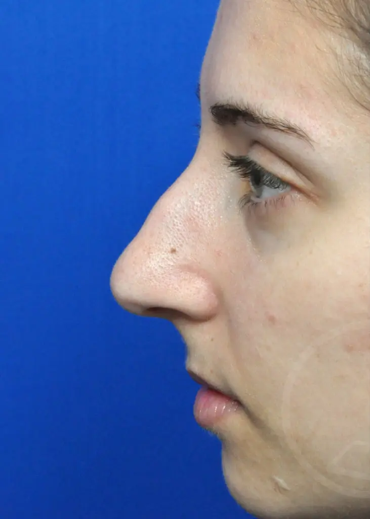 Plastic Surgery Before and After Pictures in Jacksonville, FL - Garcia Facial Plastic Surgery