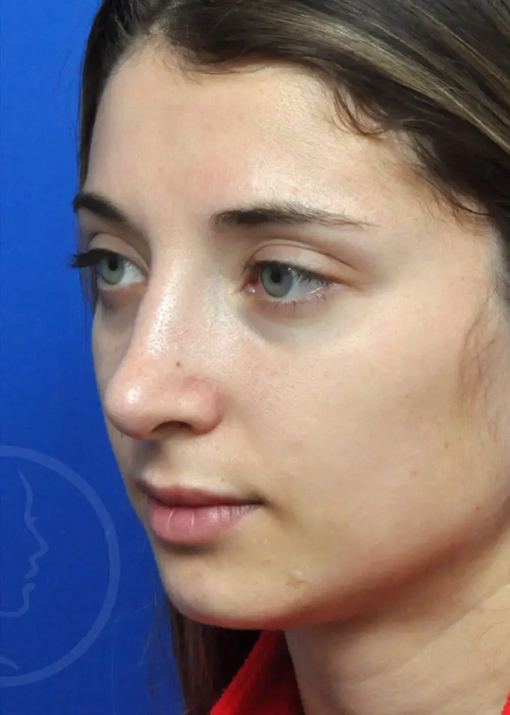 Plastic Surgery Before and After Pictures in Jacksonville, FL - Garcia Facial Plastic Surgery