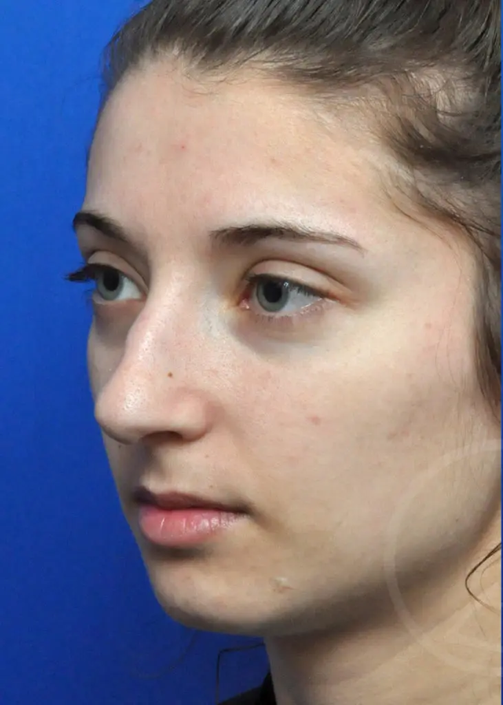 Plastic Surgery Before and After Pictures in Jacksonville, FL - Garcia Facial Plastic Surgery