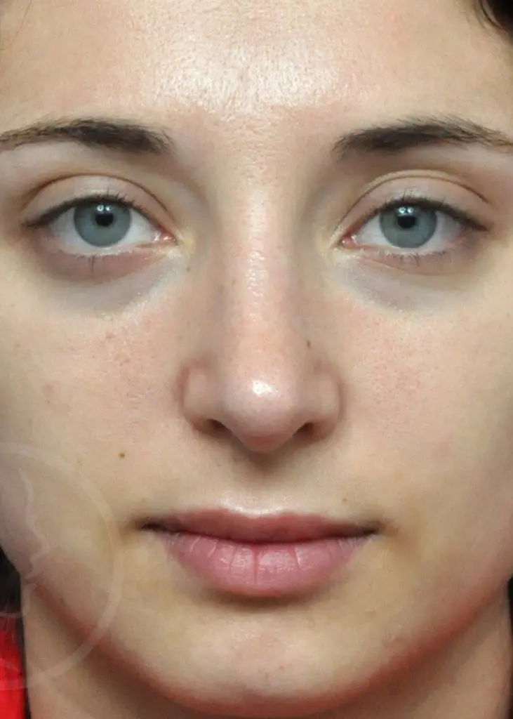 Plastic Surgery Before and After Pictures in Jacksonville, FL - Garcia Facial Plastic Surgery