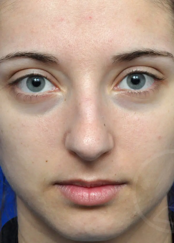 Plastic Surgery Before and After Pictures in Jacksonville, FL - Garcia Facial Plastic Surgery