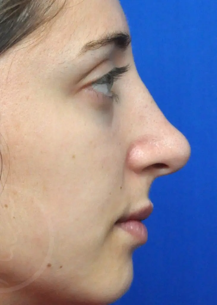 Plastic Surgery Before and After Pictures in Jacksonville, FL - Garcia Facial Plastic Surgery