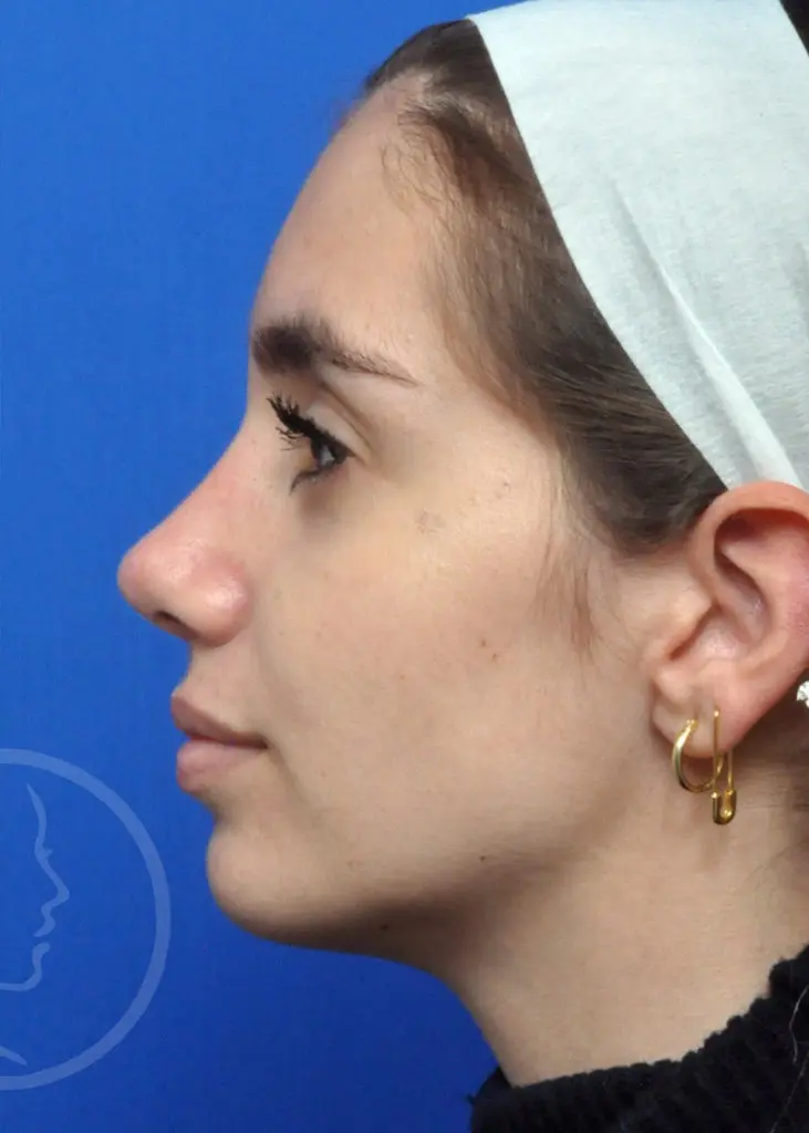 Plastic Surgery Before and After Pictures in Jacksonville, FL - Garcia Facial Plastic Surgery