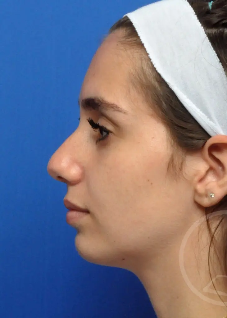 Plastic Surgery Before and After Pictures in Jacksonville, FL - Garcia Facial Plastic Surgery