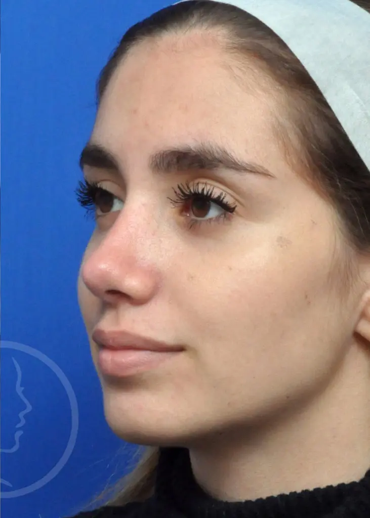 Plastic Surgery Before and After Pictures in Jacksonville, FL - Garcia Facial Plastic Surgery