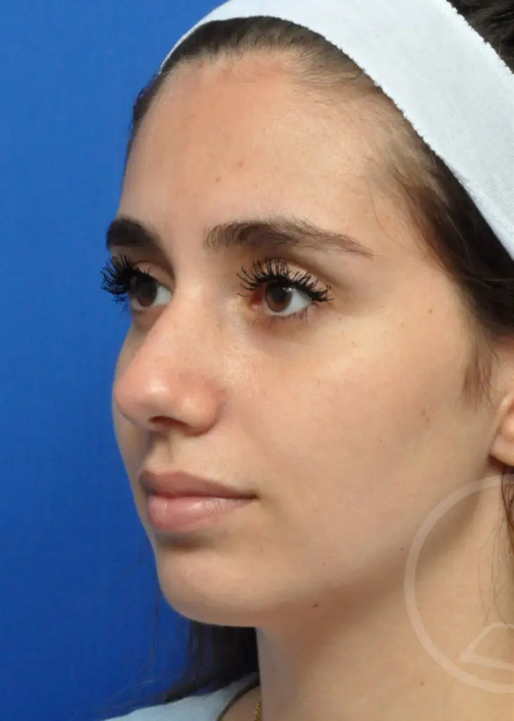 Plastic Surgery Before and After Pictures in Jacksonville, FL - Garcia Facial Plastic Surgery