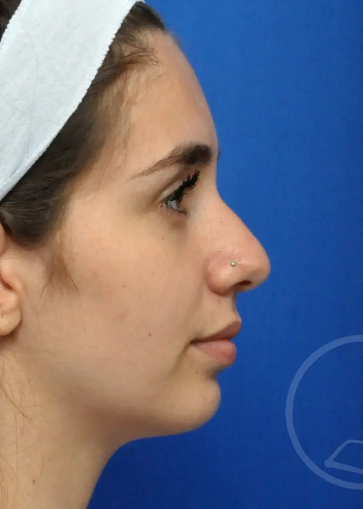 Plastic Surgery Before and After Pictures in Jacksonville, FL - Garcia Facial Plastic Surgery