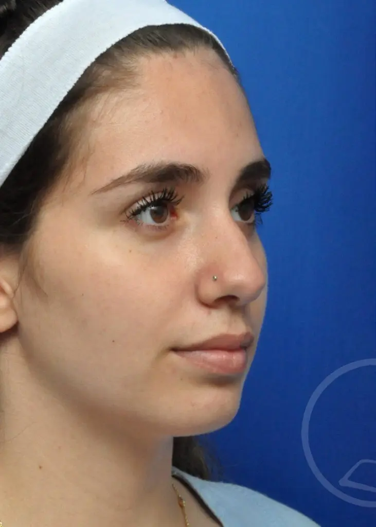 Plastic Surgery Before and After Pictures in Jacksonville, FL - Garcia Facial Plastic Surgery