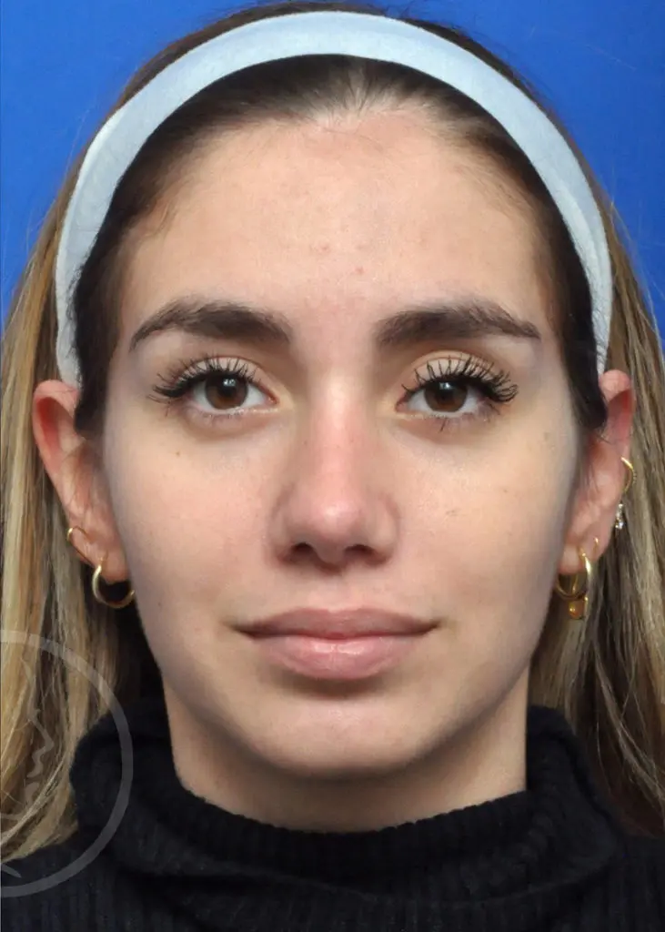 Plastic Surgery Before and After Pictures in Jacksonville, FL - Garcia Facial Plastic Surgery