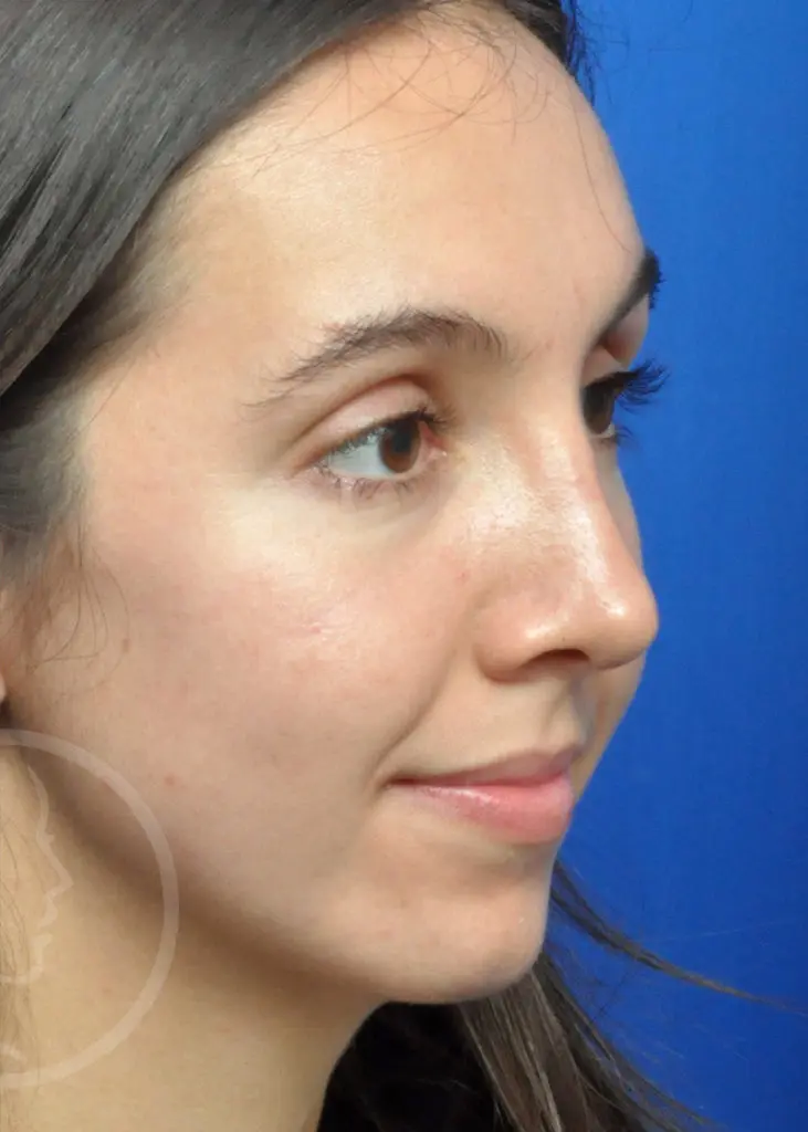 Plastic Surgery Before and After Pictures in Jacksonville, FL - Garcia Facial Plastic Surgery