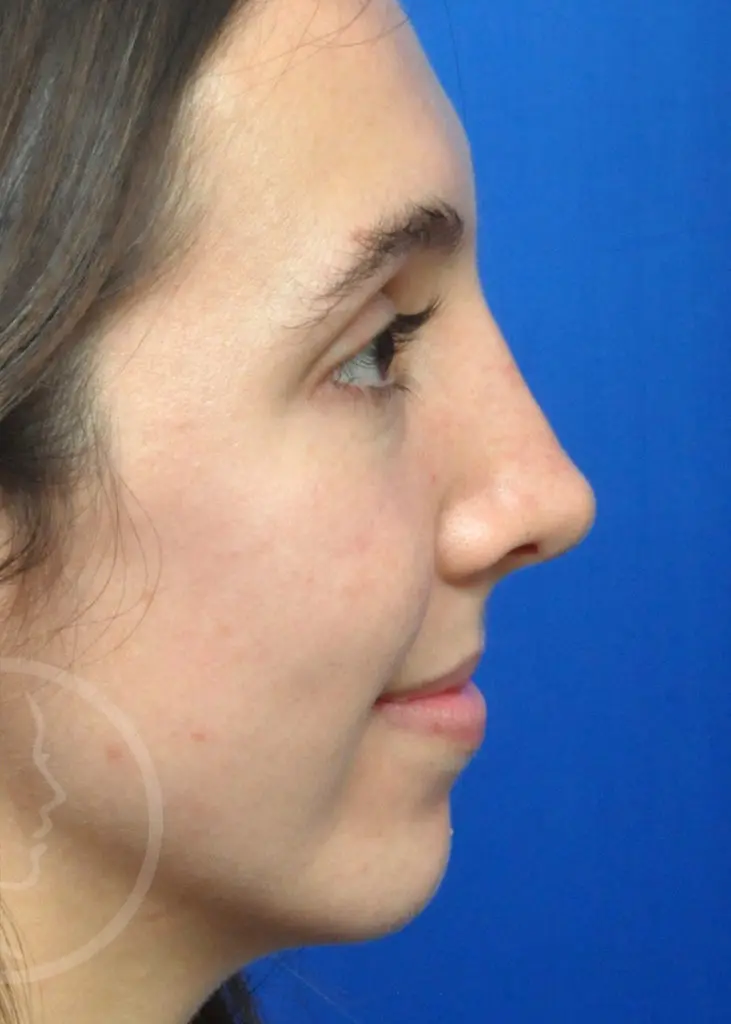 Plastic Surgery Before and After Pictures in Jacksonville, FL - Garcia Facial Plastic Surgery