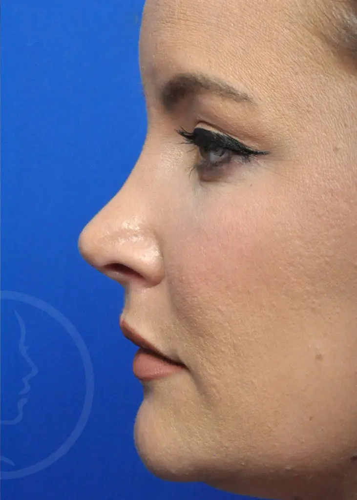 Plastic Surgery Before and After Pictures in Jacksonville, FL - Garcia Facial Plastic Surgery