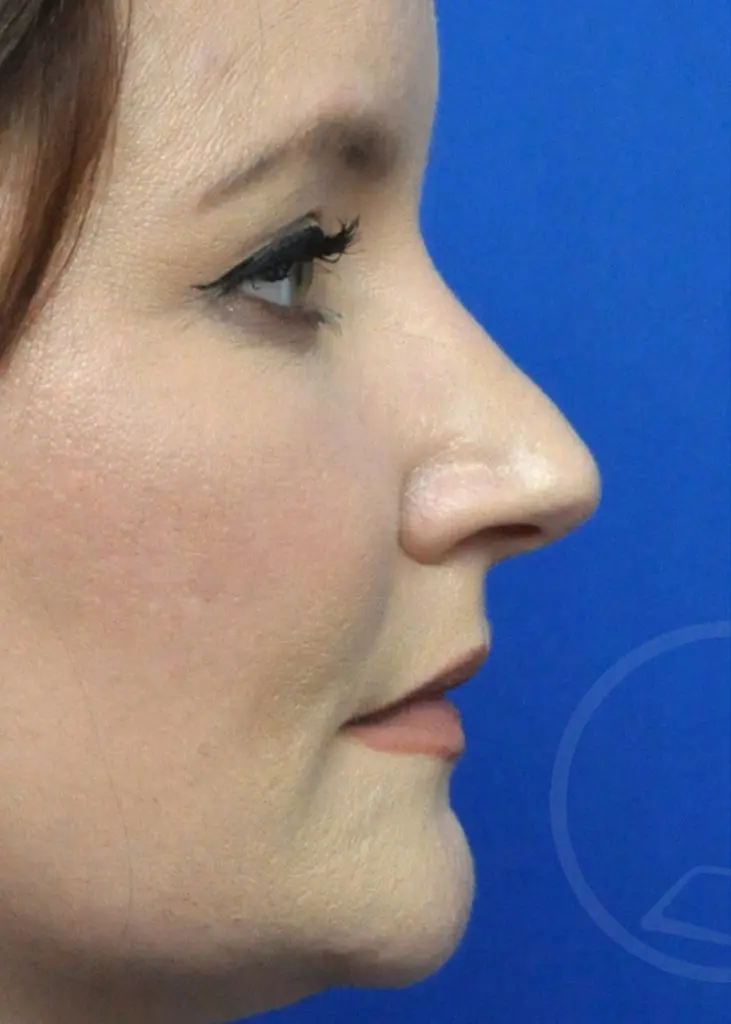 Plastic Surgery Before and After Pictures in Jacksonville, FL - Garcia Facial Plastic Surgery